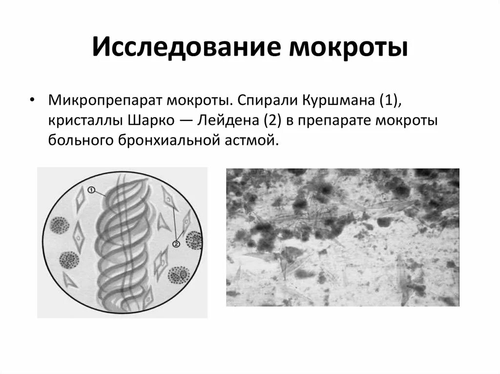 Кристаллы куршмана в мокроте. Спирали Куршмана и Кристаллы Шарко-Лейдена. Спирали Куршмана и Кристаллы Шарко-Лейдена в мокроте определяются. Спираль Куршмана в мокроте нативный препарат. Спирали Куршмана и Кристаллы Шарко-Лейдена в мокроте.