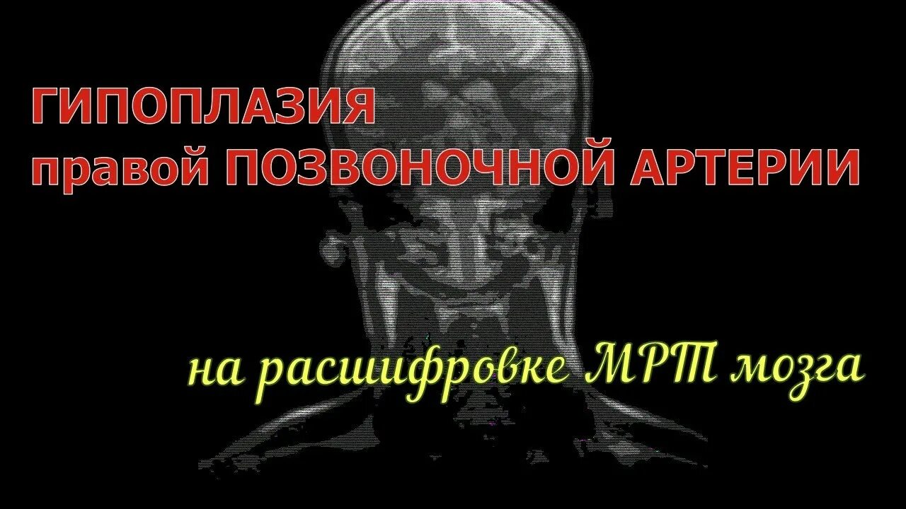 Гипоплазия позвоночной артерии. Гипоплазия правой позвоночной артерии. Гипоплазия позвоночной артерии мрт. Гипоплазия интракраниального отдела правой позвоночной артерии. Гипоплазия правой артерии головного мозга