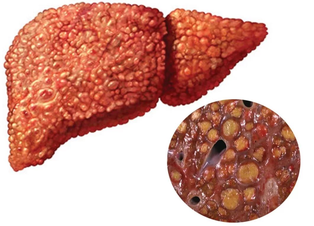 Заболевание печен. Токсический гепатит макропрепарат. Жировой гепатоз печени макро. Гепатит печени макропрепарат. Жировой гепатоз макропрепарат.