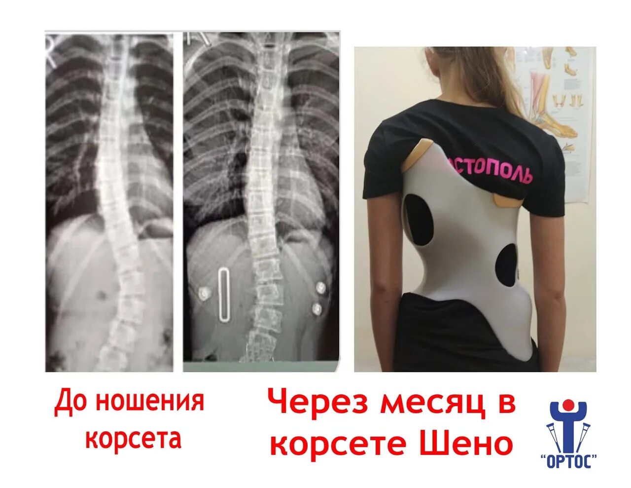 Корсет функционально-корригирующий 8-09-25. Корсет эббота-шено. Изготовление корсета шено. Изготовление корсета шено. Корсет эббота-шено.