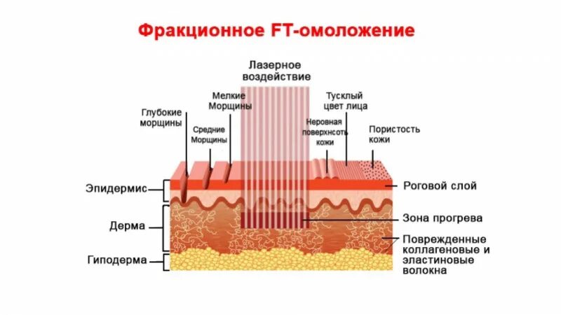 Фракционный лазер со2. Фракционный лазер принцип действия. Фракционный лазер со2 схема. Фракционное лазерное омоложение.