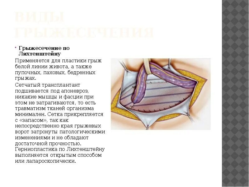 Операции по к. Пупочная грыжа операция по мейо. Пупочная грыжа операция метод мейо. Операция мейо при пупочной грыже техника. Операции мейо сапежко при пупочных грыжах.