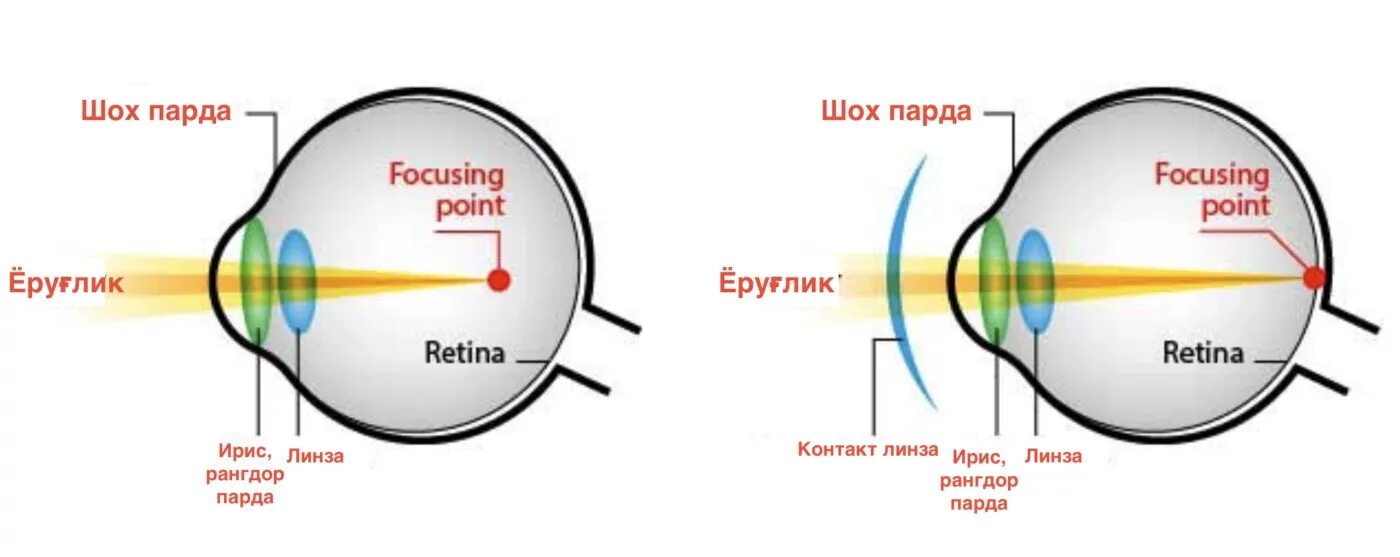 Как можно скорректировать зрение при помощи линз. Принцип работы контактных линз. Как работают контактные линзы. Контактные линзы схема. Линзы для глаз для зрения миопия.