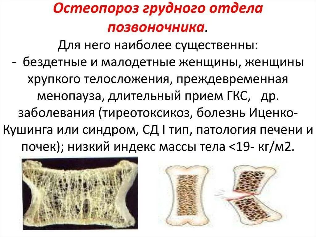 Остеопения что за болезнь лечение. Остеопения 1, 2, 3 степени. Остеопения что это такое простыми. Клиническая картина остеопороза. Остеопороз это заболевание.