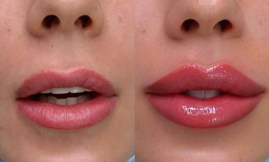 Увеличение губ lips. Техника увеличения губ бантиком. Коррекция губ.