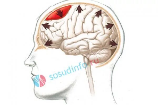 Оттек головного мозга