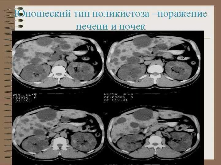 Лапароскопическая холецистэктомия - Бушуев Семен Дмитриевич