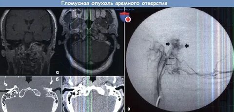 Гломусная опухоль