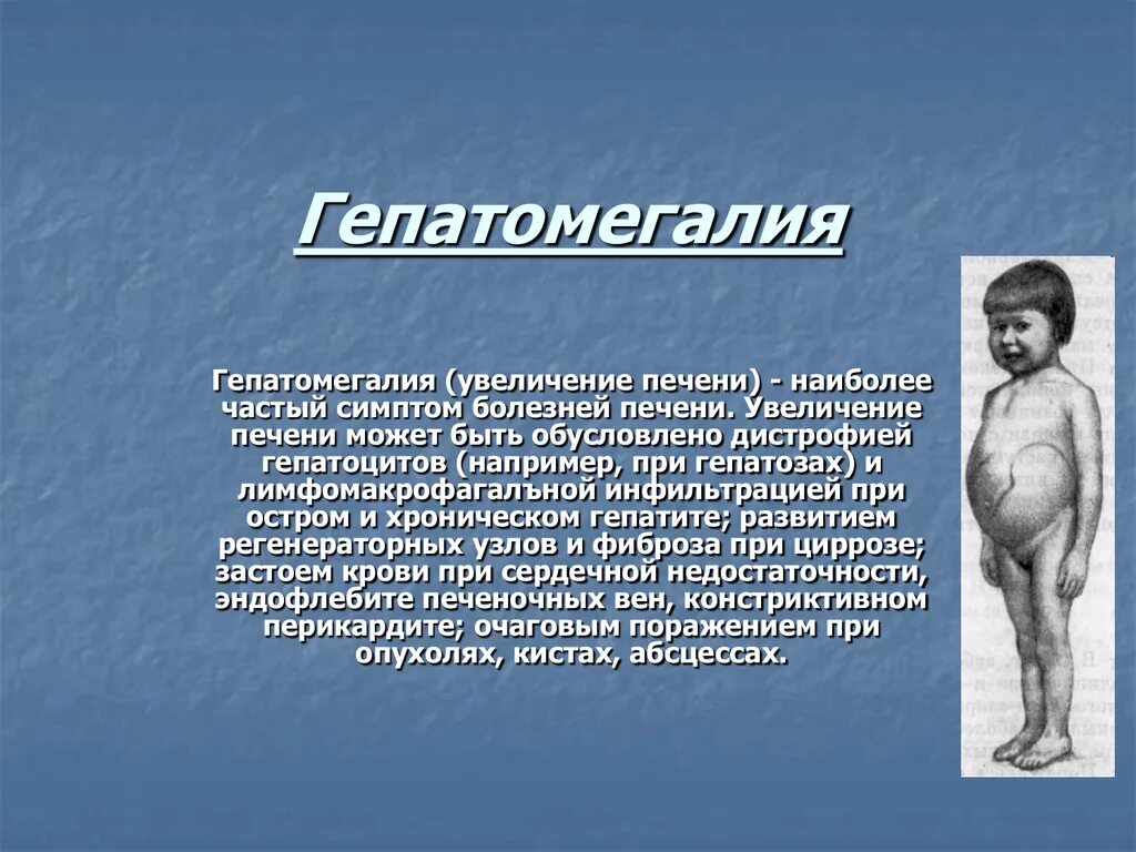 Гепатомегалия. Симптомы гепатомегалии. Гепатоспленомегалия гепатомегалия. Заболевания при гепатомегалии.