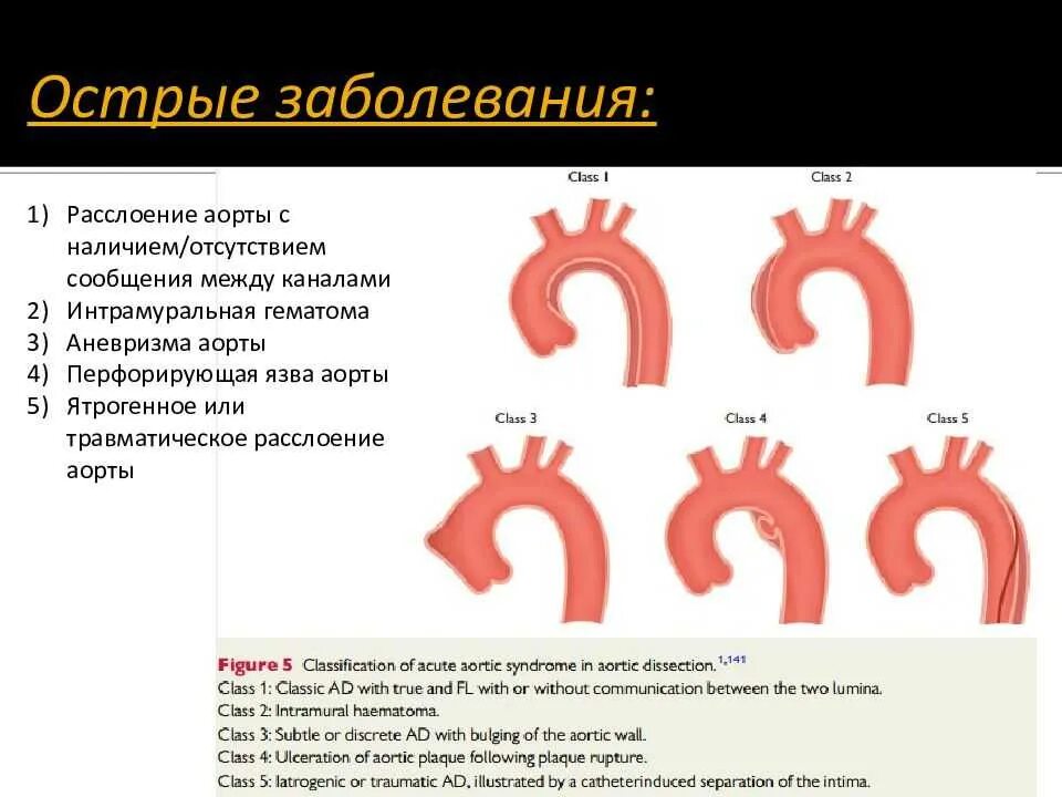 Расслаивающаяся аневризма аорты. Расслаивающаяся аневризма аорты классификация. типы острого расслоения аорты. классификация аневризм аорты кт. расслаивающая аневризма классификация.