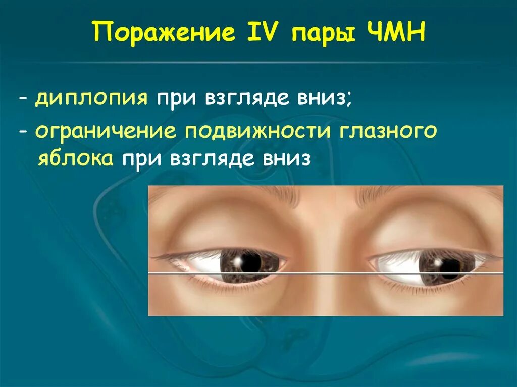 Поражение 4 пары ЧМН. Поражение 6 пары ЧМН. Парез III пары черепно-мозговых нервов. Поражение 3 нерва