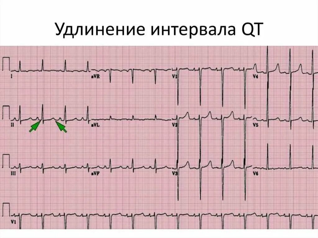 Qt c интервал. Qt c интервал