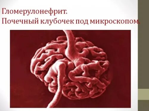 Гломерулонефрит у пожилых. Гломерулонефрит у пожилых