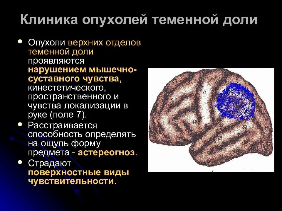 Опухоль теменной доли головного мозга. Опухоль теменной доли головного мозга симптомы. Опухоли теменной доли клиника. Опухоль левой теменной доли головного мозга. Опухоли теменной