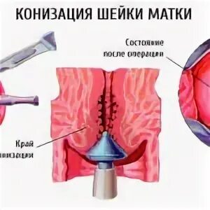 Больно ли делать конизацию шейки матки: отзывы, как проходит операция oldchampio