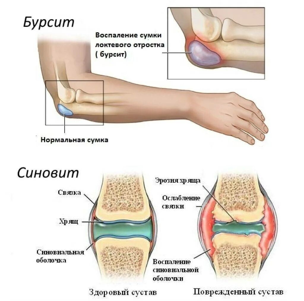 Эффективное лечение бурсита локтевого. Синовит локтевого сустава. Бурмит отростка локтевого. Бурсит локтевого отростка рентген. Бурсит воспаление суставной сумки.