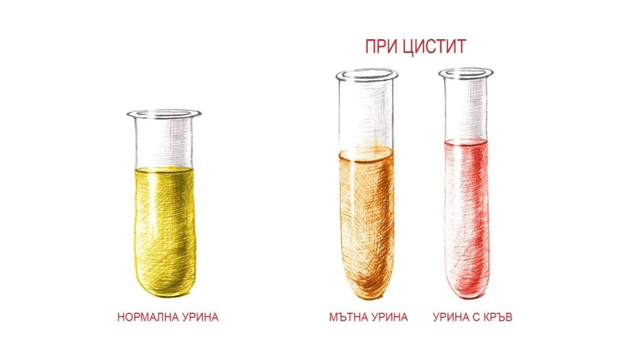 Теплая бутылка между ног при цистите. Цвет крови при цистите. Бутылка с теплой водой при цистите. Грелка между ног при цистите. Цистит горячая вода