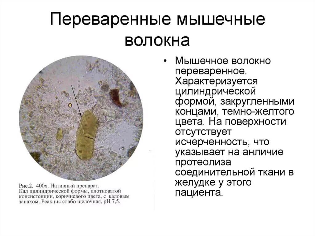 Микроскопия кала мышечные волокна. Мышечные волокна с исчерченностью в микроскопии кала. Микроскопия кала переваренные мышечные волокна. Норма в Кале мышечные волокна с исчерченностью. Грибы в копрограмме у взрослого