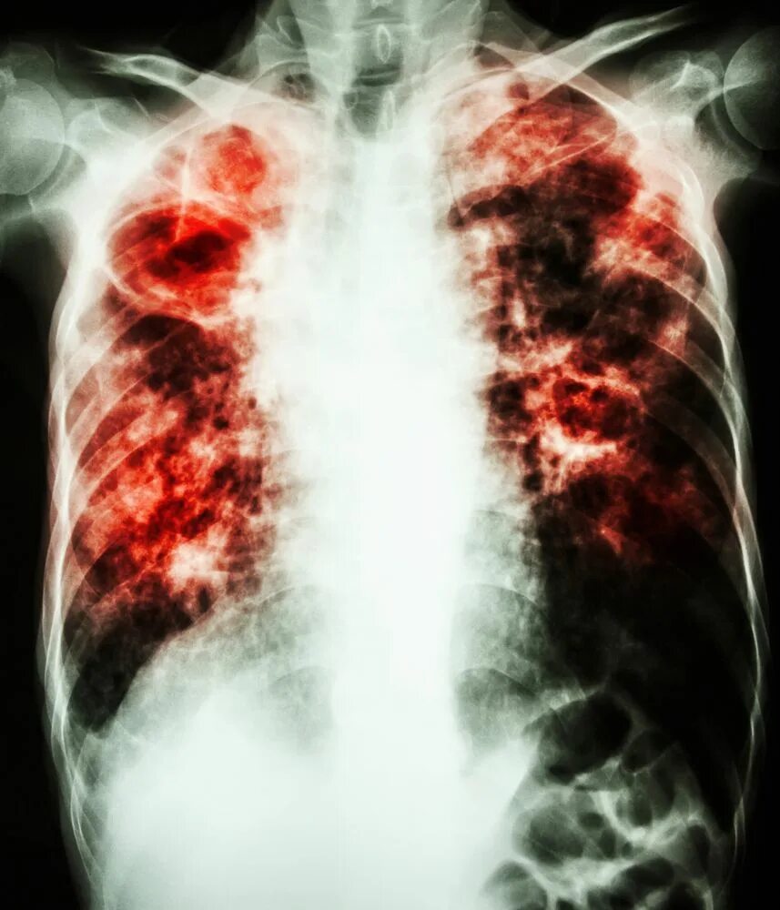 Tuberculosis disease. Tuberculosis disease. Tuberculosis disease. Types of tb. Иконка заболевание легких.