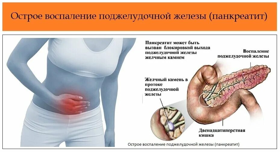 Острый живот панкреатит. Факторы вызывающие панкреатит. Поджелудочная железа симптомы. Панкреатит поджелудочной железы. Панкреатит в поджелудочной железе.