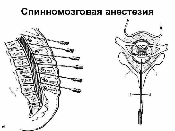 Спинальная анестезия место пункции. Спинномозговая анестезия методика. Спинномозговая анестезия схема. Спинальная анестезия схема.