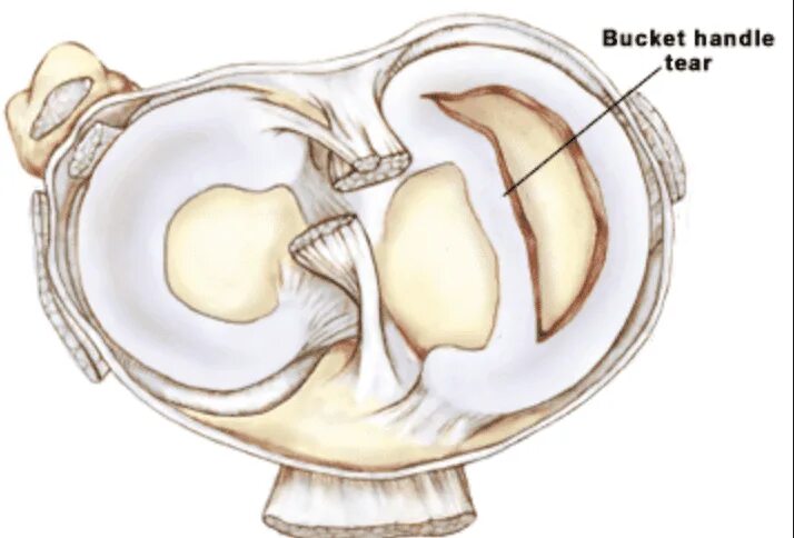 Разрыв рога медиального мениска. Разрыв заднего рога медиального мениска. Разрыв рога медиального мениска коленного сустава. Разрыв заднего рога медиального мениска мениска. Передний рог коленного сустава