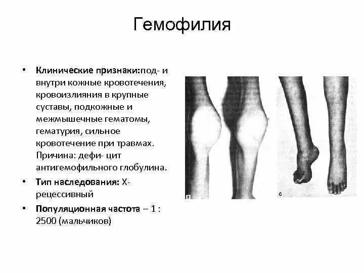 Характерный клинический признак гемофилии. Гемофилия основные проявления болезни. Основные клинические симптомы гемофилии.