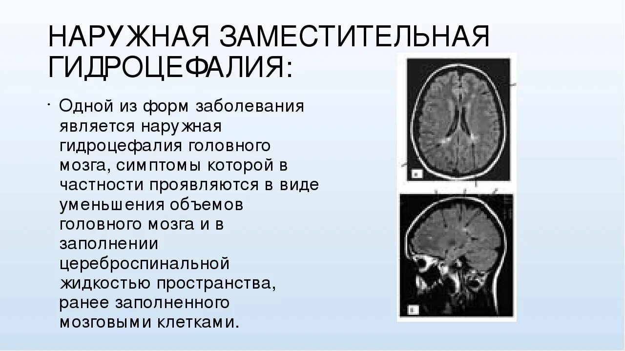 Выраженная заместительная гидроцефалия. Наружная гидроцефалия головного мозга мрт. Заместительная наружная гидроцефалия кт. Гидроцефалия головного мозга на кт. Наружная и внутренняя гидроцефалия головного мозга.