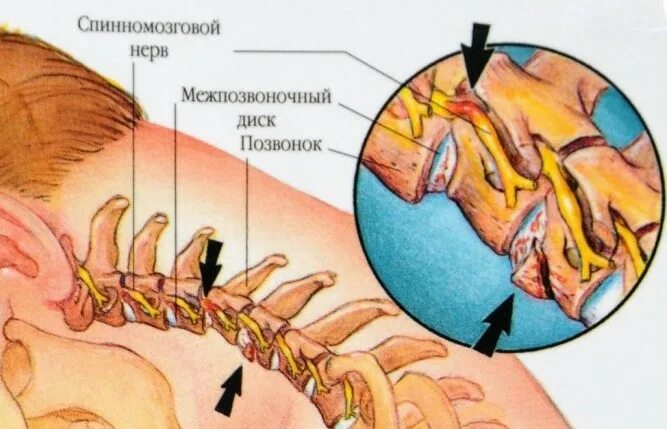Синдром цервикалгии. Цервикалгия шейного отдела позвоночника что это такое. синдром цервикалгии шейный отдел. шейный остеохондроз цервикокраниалгия. краниоцервикалгия шейного отдела.