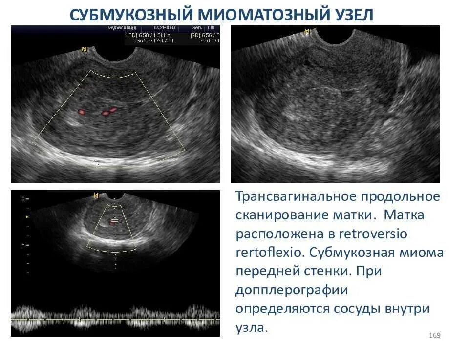 Эндометрия сосудов. Подслизистый миоматозный узел УЗИ. Миоматозный узел матки на УЗИ. УЗИ признаки миомы тела матки.