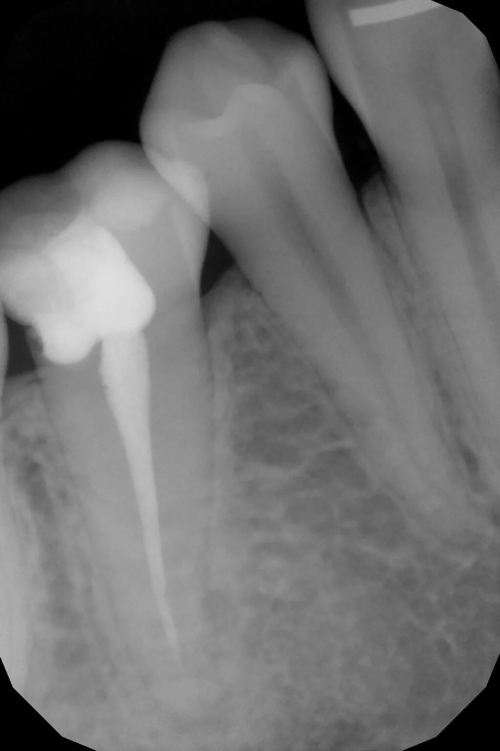 Запломбированный канал зуба. Снимок запломбированного зуба. Плохо запломбированные каналы зуба.