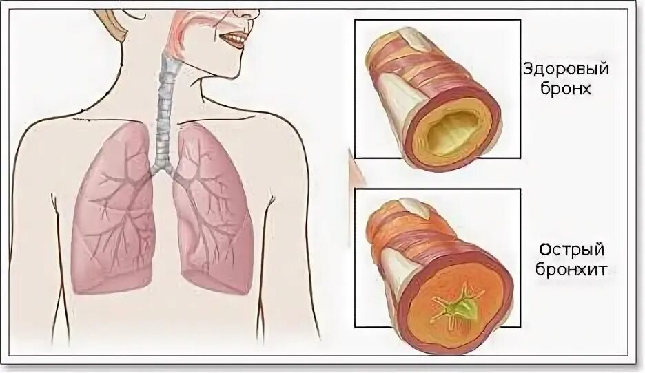 Легкие при остром бронхите. Острый бронхит с поражением крупных бронхов. У ребенка легкий бронхит
