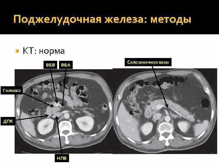 Кальцификация поджелудочной железы кт. Селезеночная Вена норма на кт. Плотность поджелудочной железы на кт. Контрастирование поджелудочной железы кт. Кт норма печень