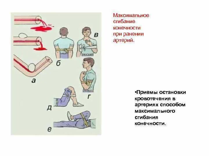 Остановка кровотечения путем сгибания конечности. Максимальное сгибание конечности. Максимальное сгибание конечности при кровотечении. Остановка кровотечения сгибанием конечности.