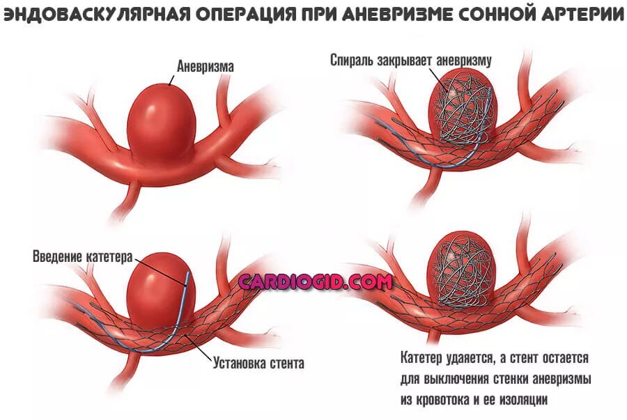 Аневризма сонной артерии что это. Аневризмы сонной артерии. Аневризм сонной артерии. Аневризма ВСА головного мозга. Фузиформная аневризма сонной артерии.