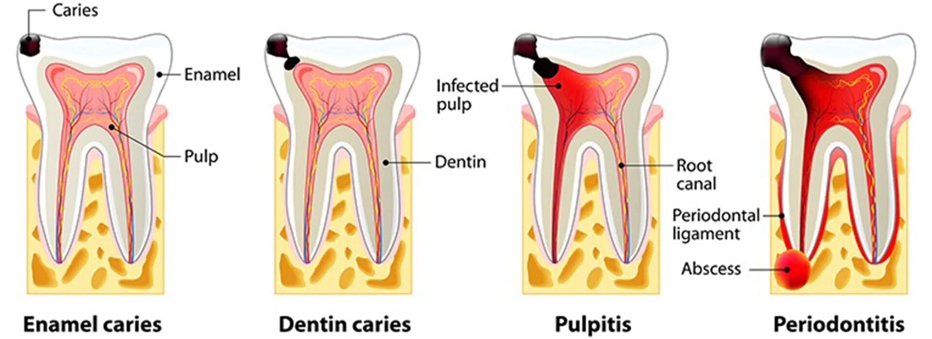 Этапы пульпита периодонтит. Кариес эмали дентина и цемента. Осложнение лечения периодонтита
