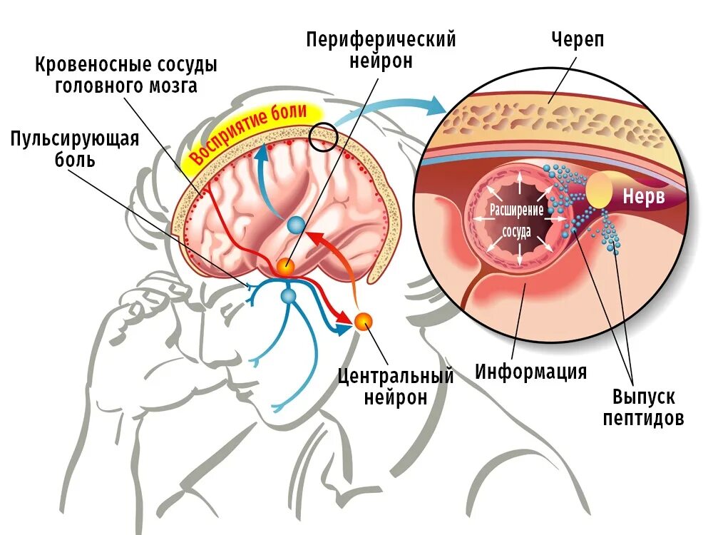 Головная боль сосуды головы. Вестибулярная мигрень. Механизм мигрени. Механизм головной боли. Мигрень симптомы.