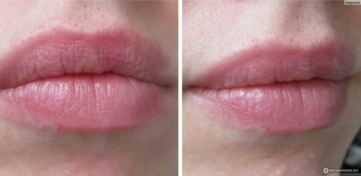 Губы после крема радевит. Увлажнение губ ювидерм. Чем увлажнить губы очень сухие. Увлажнение для губ в домашних. Чем увлажнить губы очень сухие.