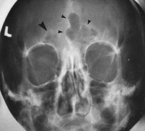 Лобная аплазия. Гипоплазия лобной пазухи на кт. Гипоплазия лобных пазух рентген. Лобная аплазия. Лобная аплазия.