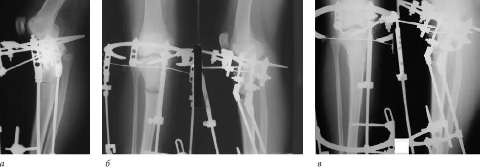 Компрессионно-дистракционный аппарат Илизарова. Остеосинтез голени аппаратом Илизарова рентген. Чрескостный остеосинтез аппаратом Илизарова. Аппарат Kroner остеосинтез. Осложнения остеосинтеза