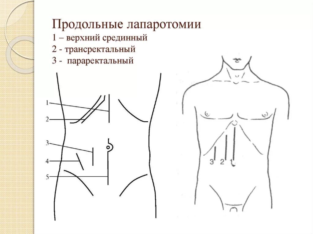 Какое лапаротомия. Верхняя срединная лапаротомия шов. Срединная поперечная лапаротомия. Срединная лапаротомия схема. Трансректальная лапаротомия по Ленандеру.