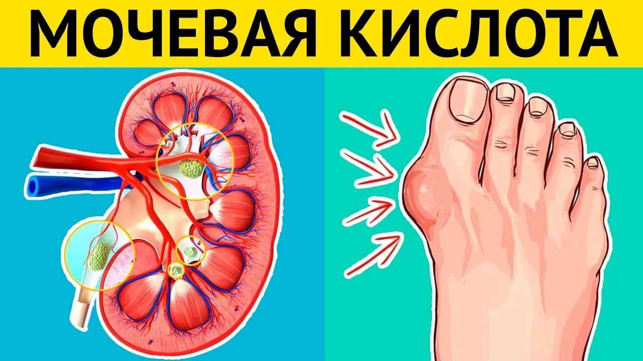 Вывести мочевую кислоту из организма. Мочевая кислота в организме. Повышение мочевой кислоты. Подагра и повышенная мочевая кислота. Против мочевой кислоты