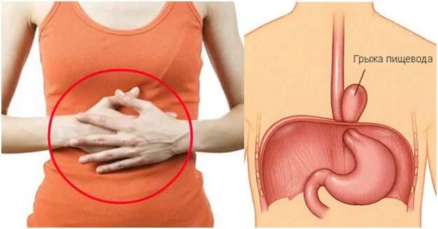 Грыжа пищевода признаки симптомы. Грыжа пищеводного желудка.