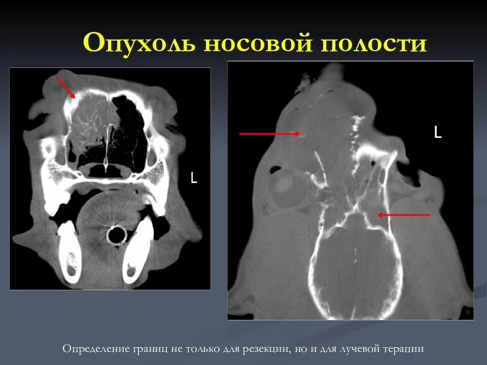 Злокачественные новообразования носа и околоносовых пазух. Новообразования носа и околоносовых пазух. Доброкачественные опухоли полости носа. Синоназальная папиллома. Опухоль носовой раковины кт.