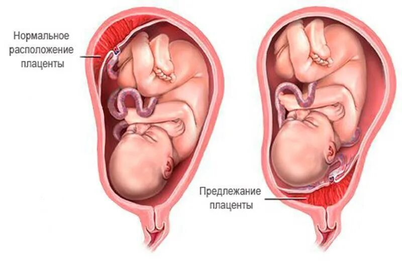 Предлежание плаценты. Полное предлежание плаценты при беременности. Маргинальное предлежание плаценты. Полное предлежание плода при беременности. Ребенок расположен справа