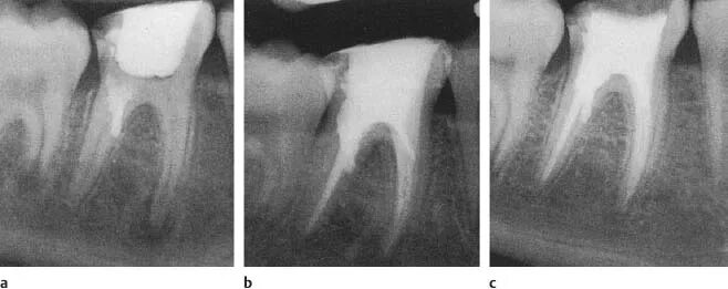 Расширение каналов зубов. Апикальный периодонтит. Периодонтит зуба снимок. Перфорация корня зуба при пломбировании.