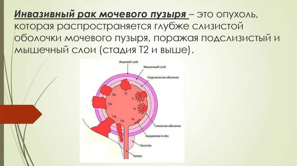 Рак мочевого сколько живут