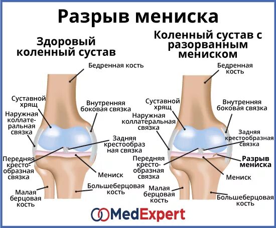 Повреждение мениска коленного сустава симптомы. Артроз мениска коленного сустава. Мениск коленного сустава рентген. Симптомы повреждения менисков коленного сустава. Передний рог коленного сустава