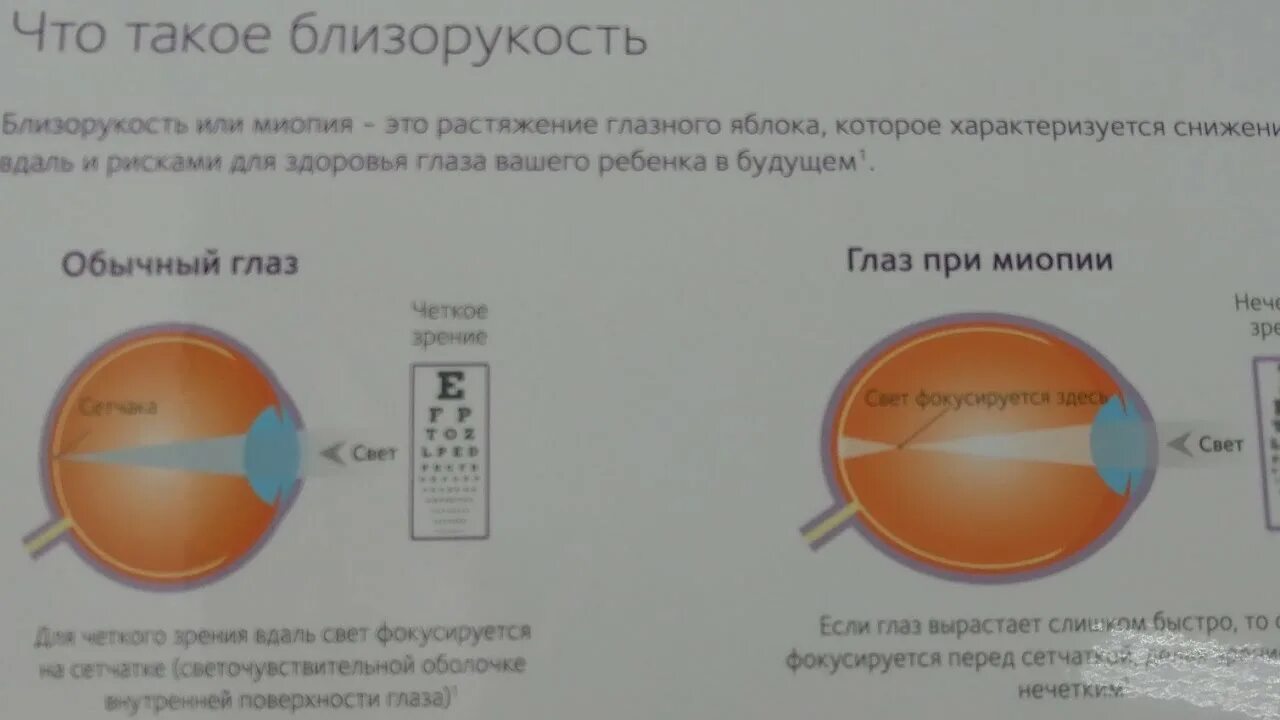 Прогрессирующая миопия. Прогрессирование миопии. Критерии прогрессирования миопии. Быстро прогрессирующая близорукость. Слабая миопия глаза что