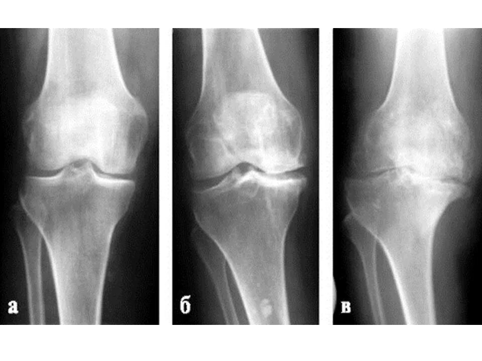Гонартроз 2 степени коленного сустава рентген. Деформирующий гонартроз рентген. Гонартроз коленного сустава 1 степени на рентгене. Гонартроз 1 степени на рентгене.